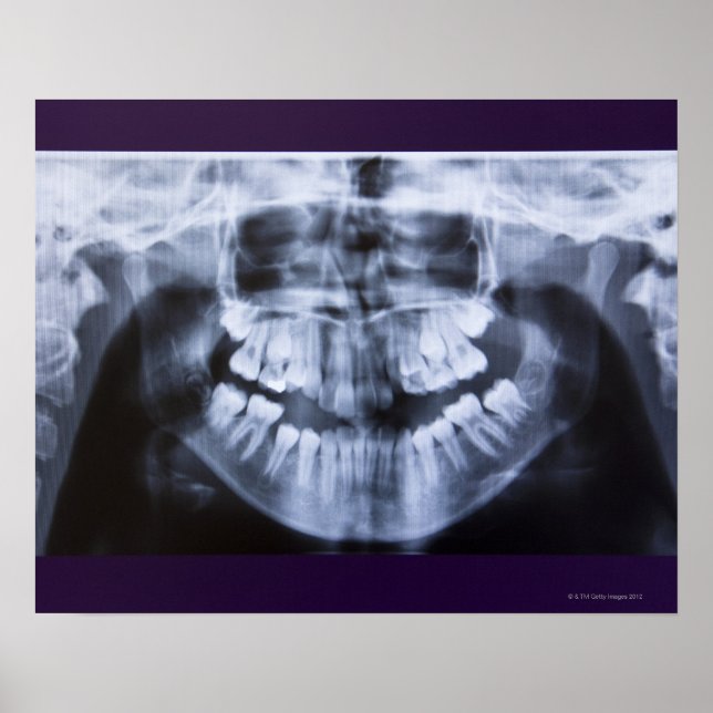 Poster Xray de um jawline feminino levado com panorâmica (Frente)