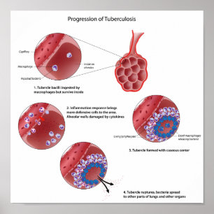 Progressão do Poster de tuberculose pulmonar