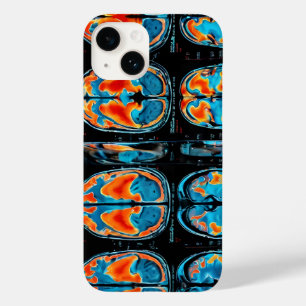 ressonância magnética cerebral
