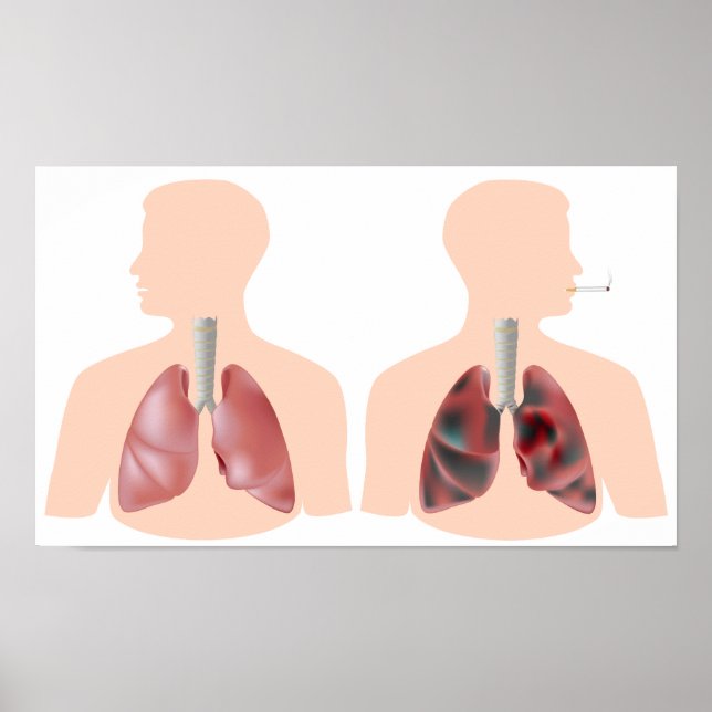 Smoking and lung cancer Poster (Frente)