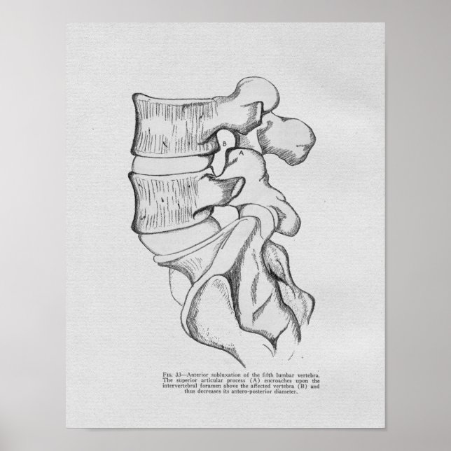 Subluxação Vertebral Quiroprática Impressão (Frente)