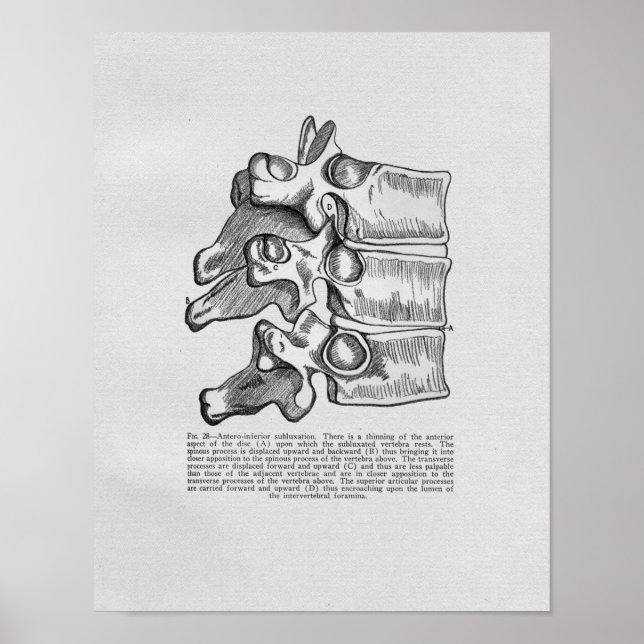 Subluxação Vertebral Quiroprática Impressão (Frente)