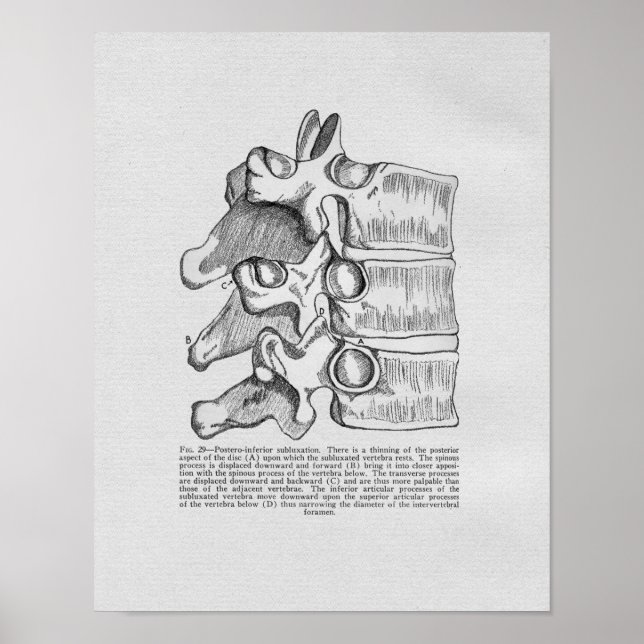 Subluxação Vertebral Quiroprática Impressão (Frente)