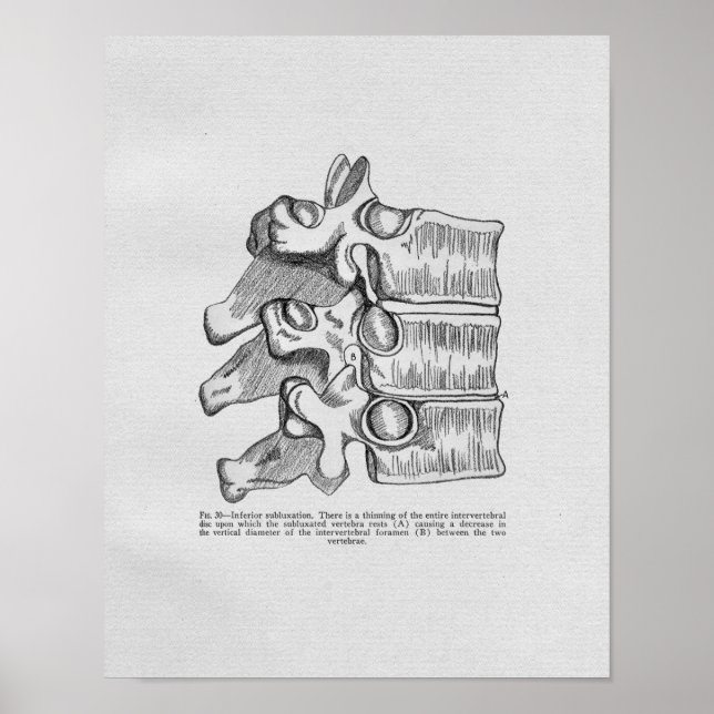 Subluxação Vertebral Quiroprática Impressão (Frente)