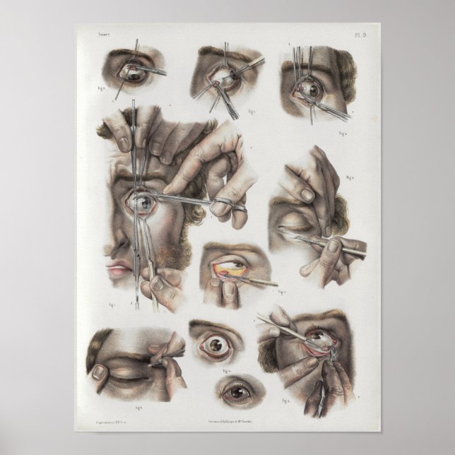 Técnica De Cirurgia Ocular Impressão de Anatomia V (Frente)